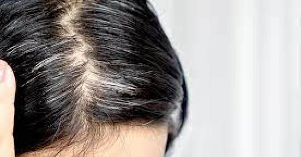 5 Cara Alami Mengatasi Uban di Rambut  yang Mulai Tumbuh di Bagian Kepala Anda 
