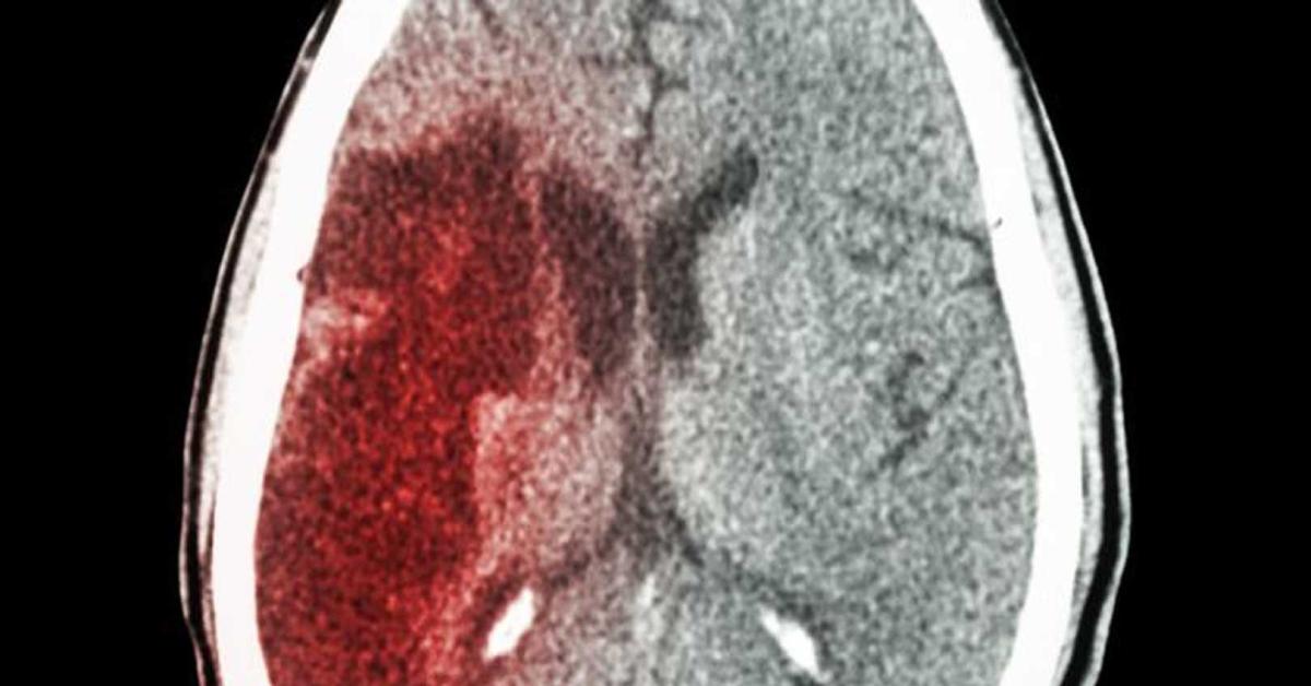 Mengenal Headstroke: Pencegahan dan Pengobatannya