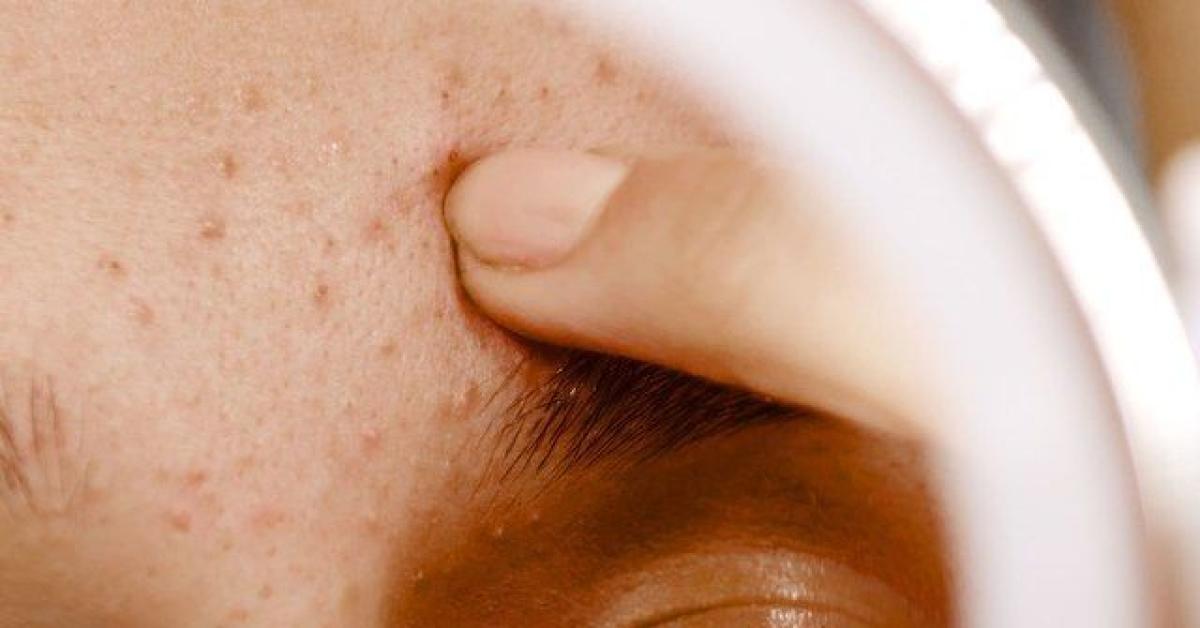 Rekomendasi Face Wash Ini Ampuh Untuk Hilangkan Jerawat Dan Bekasnya