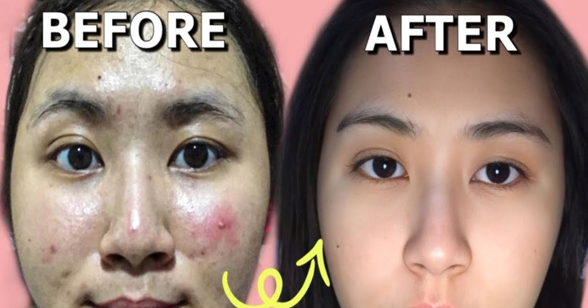 Simak Cara Ini untuk Berantas Jerawat Batu Secara Efektif dan Tanpa Bekas!