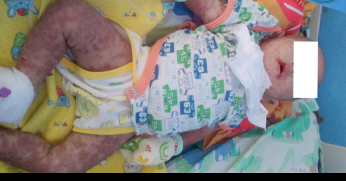 Kulit Bayi di Bandar Lampung Melepuh Usai Diberi Obat Racikan dari Bidan