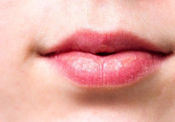 Bibir Kering Pecah-pecah, Buka Mulut Saja Sakit? Ini Penyebabnya