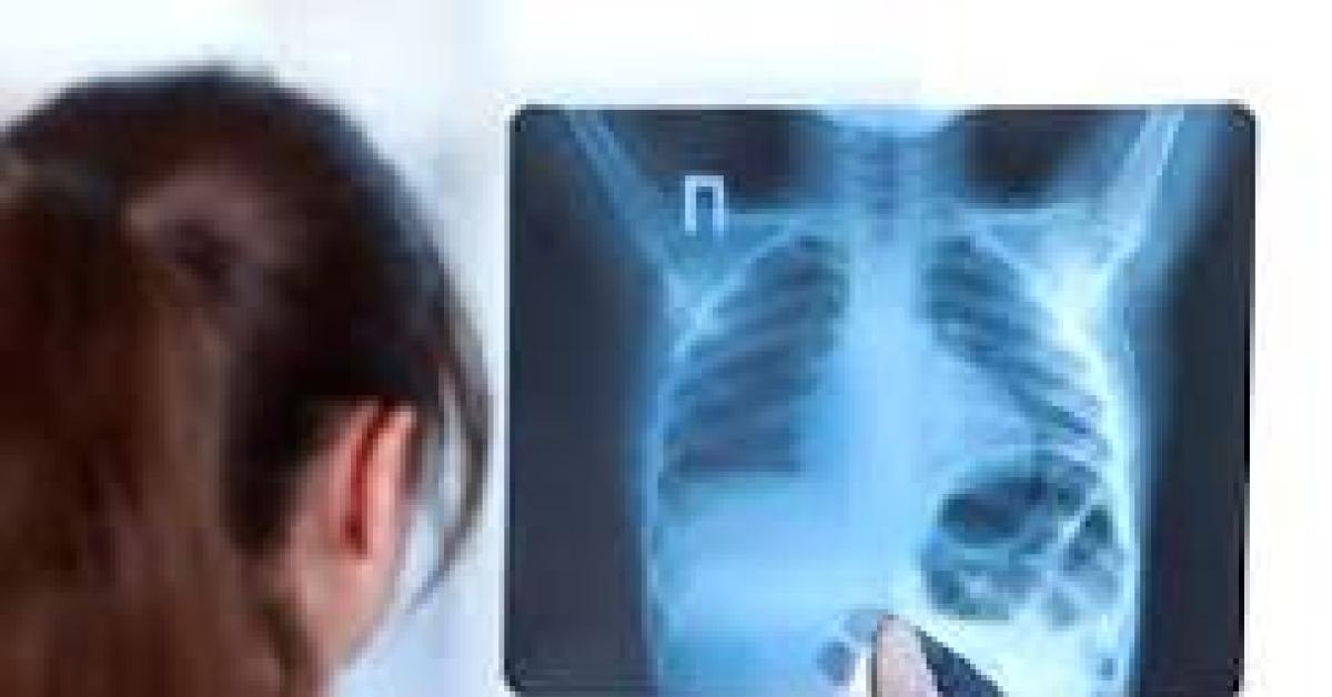 Simak Gejala dan Penyebab serta Diagnosis Paru-Paru Basah