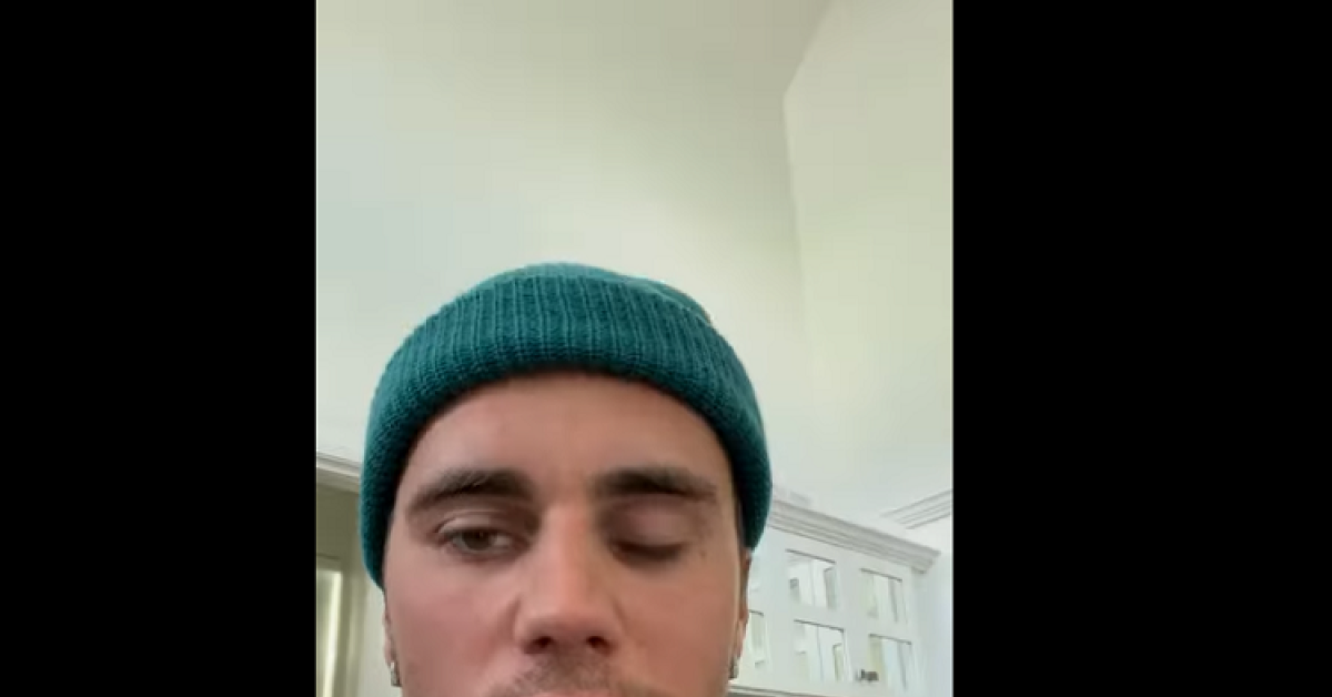 Ngeri! Wajah Justin Bieber Lumpuh Separuh: Aku Mengidap Ramsay Hunt Syndrome 