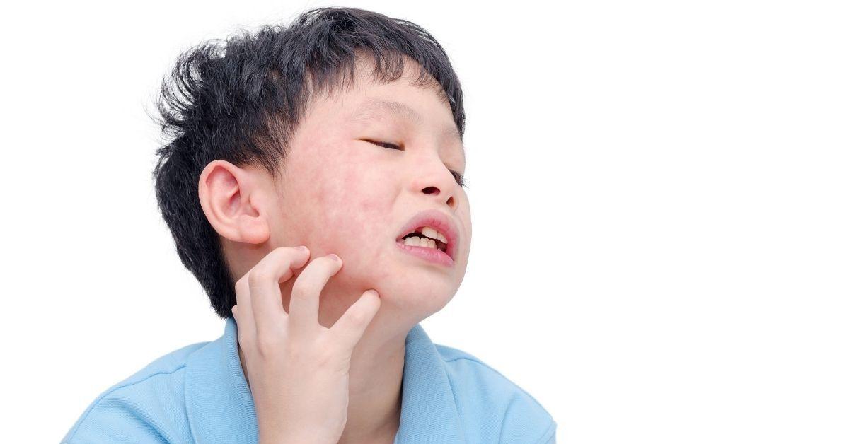 Ibu Jangan Panik! Simak Cara Mudah Atasi Alergi Kulit Pada Anak