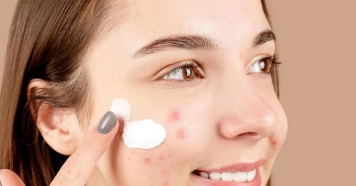 5 Rekomendasi Pelembab Wajah untuk Kulit Muka Berjerawat