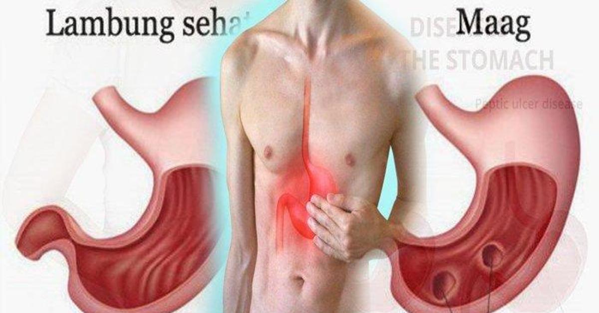 Puasa Bisa Ringankan Gejala Maag dan GERD, Simak Penjelasannya di Sini