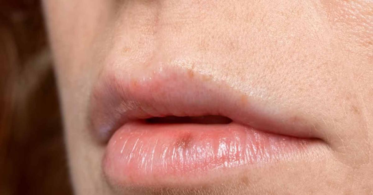 Mengobati Bibir Pecah-Pecah: Tips dan Pengobatan yang Efektif