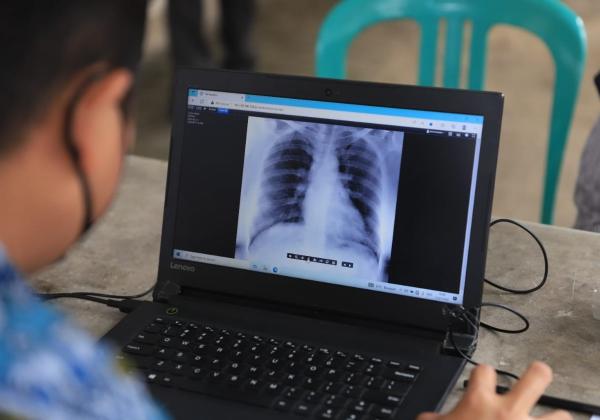 Tahun 2022, Angka TBC di Kabupaten Tangerang Capai 8.941 Kasus