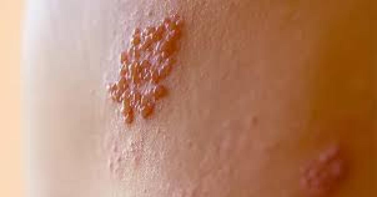 Apa itu Herpes zoster yang Viral di MEDSOS? Bagaimana Gejalanya?
