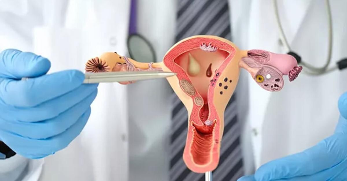 Polycystic Ovary Syndrome, Kenali dan Atasi Gangguan Hormonal yang Ganggu Kesuburan Wanita