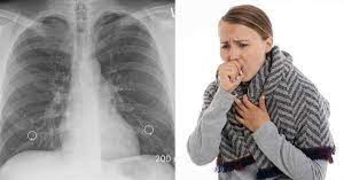 Tanda - Tanda Paru - Paru Basah, Segera Ke Dokter jika Merasakan Gejala Ini Untuk Segera Ditangani 