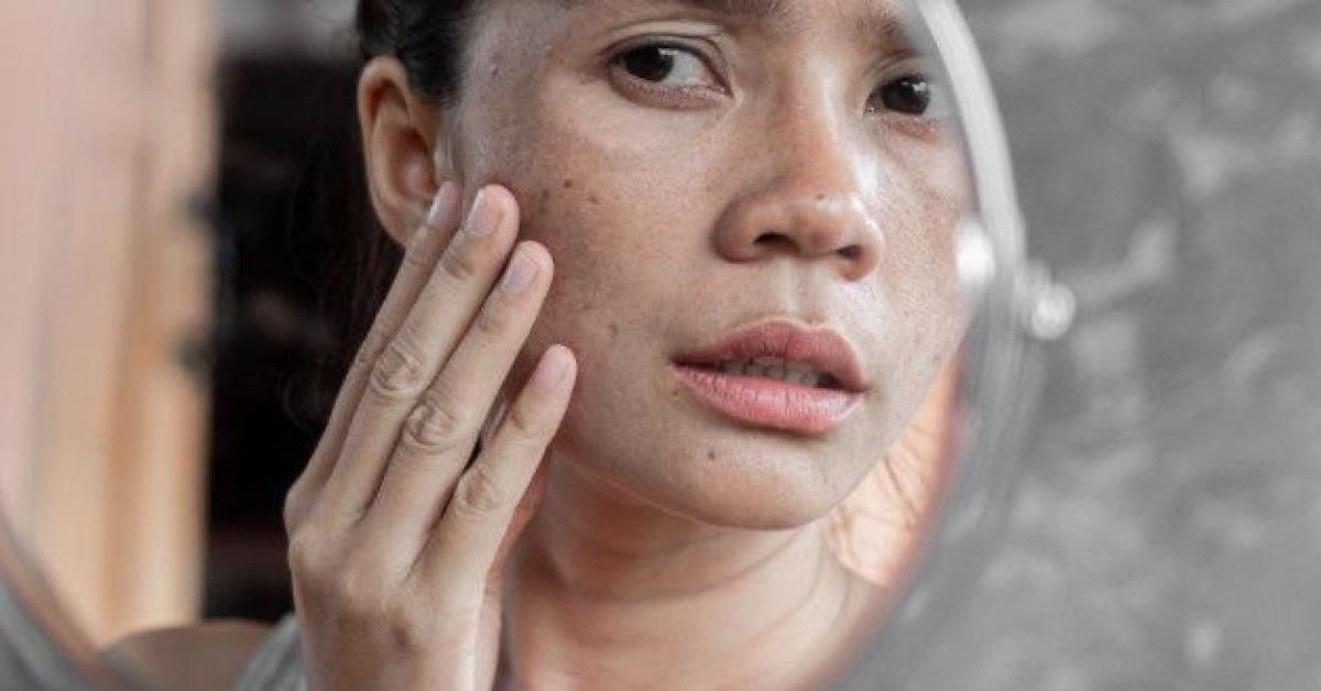 Simak Tips Ini Untuk Menghilangkan Flek Hitam Pada Wajah Secara Efektif