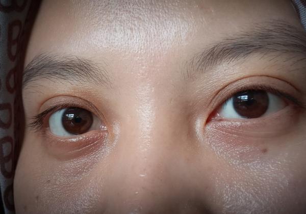 Cara Menghilangkan Mata Panda, Tips Ampuh Agar Tampil Lebih Fresh!