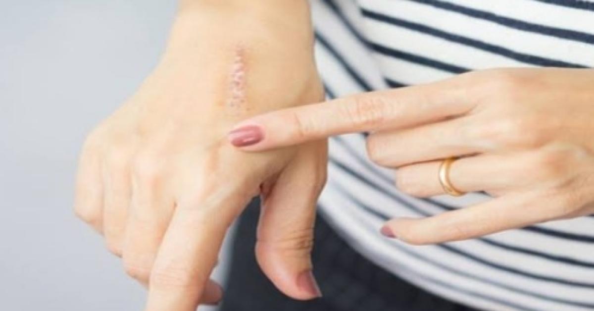 5 Cara Menghilangkan Bekas Luka Membandel, Bahan Perawatan Kulit Secara Alami