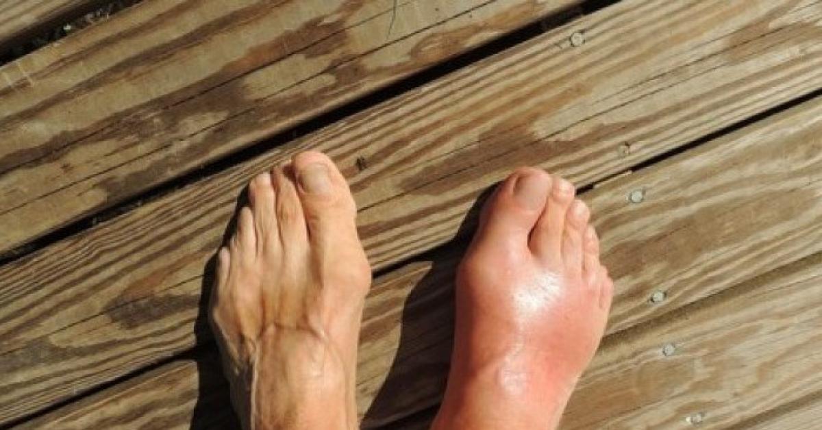4 Jenis Obat Asam Urat, untuk Menurunkan Bengkak Pilih yang Ini