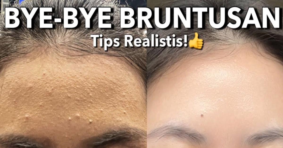 Mengatasi Kulit Bruntusan: Penyebab, Tips Ampuh, dan Produk Rekomendasi untuk Remaja