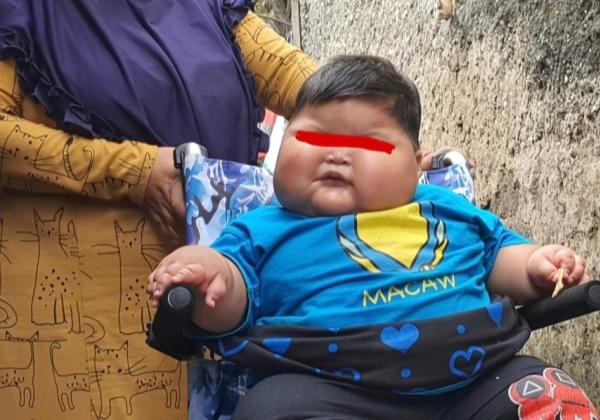 Pemkab Bekasi Janji Tanggung Penuh Biaya Tindakan Medis Kenzie, Bayi Obesitas Dengan Berat Badan 27kg