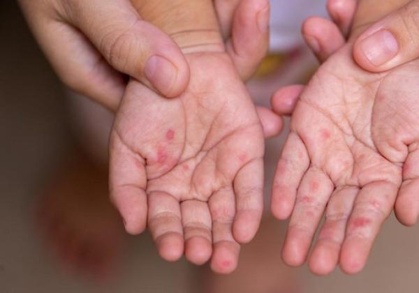Jutaan Anak Indonesia Terancam Penyakit Menular Gegara Mitos dan Larangan Keluarga