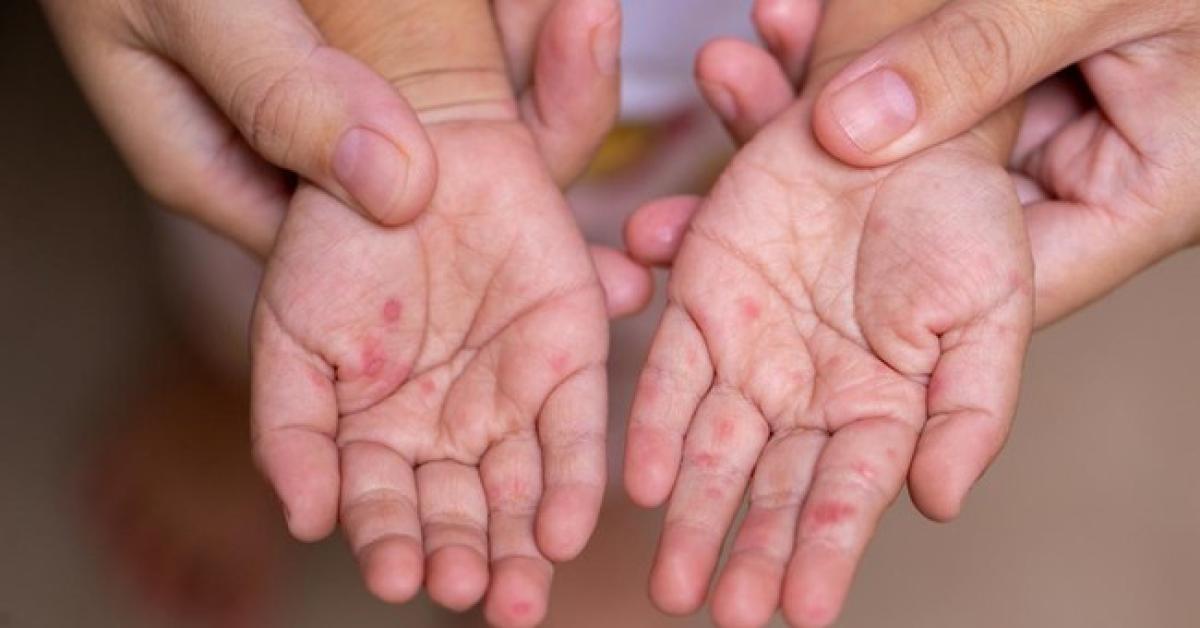 Jutaan Anak Indonesia Terancam Penyakit Menular Gegara Mitos dan Larangan Keluarga