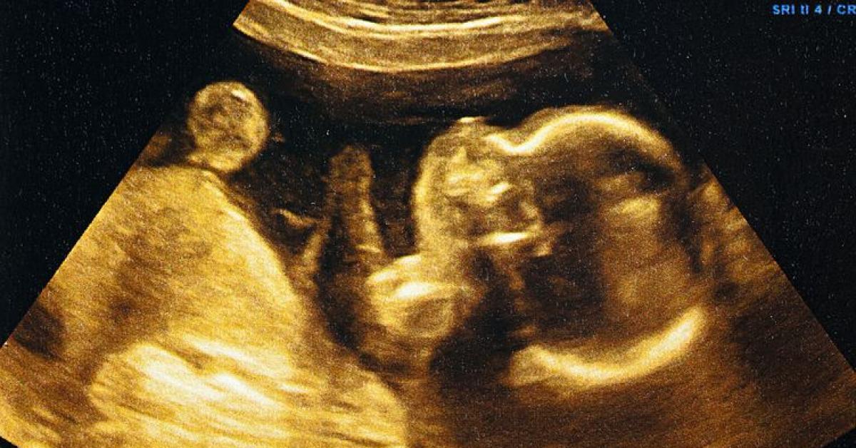 Apa itu Fetus In Fetu? Penyakit Langka yang Diidap Bayi 5 Bulan di Sumbar