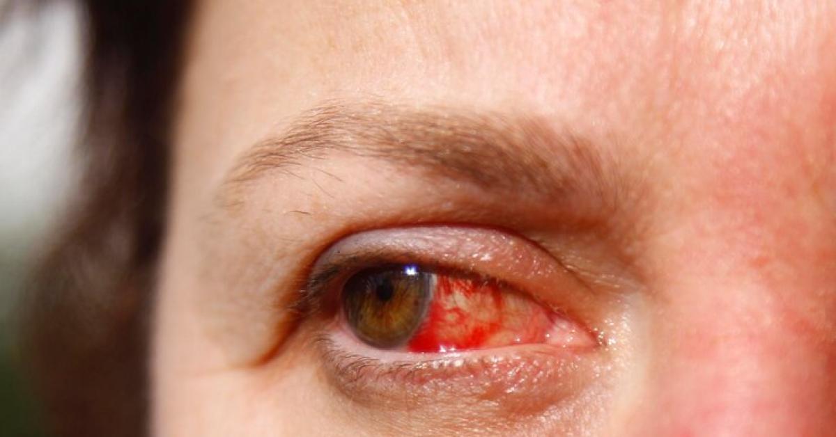 5 Penyebab Mata Merah yang Paling Umum dan Cara Meredakannya