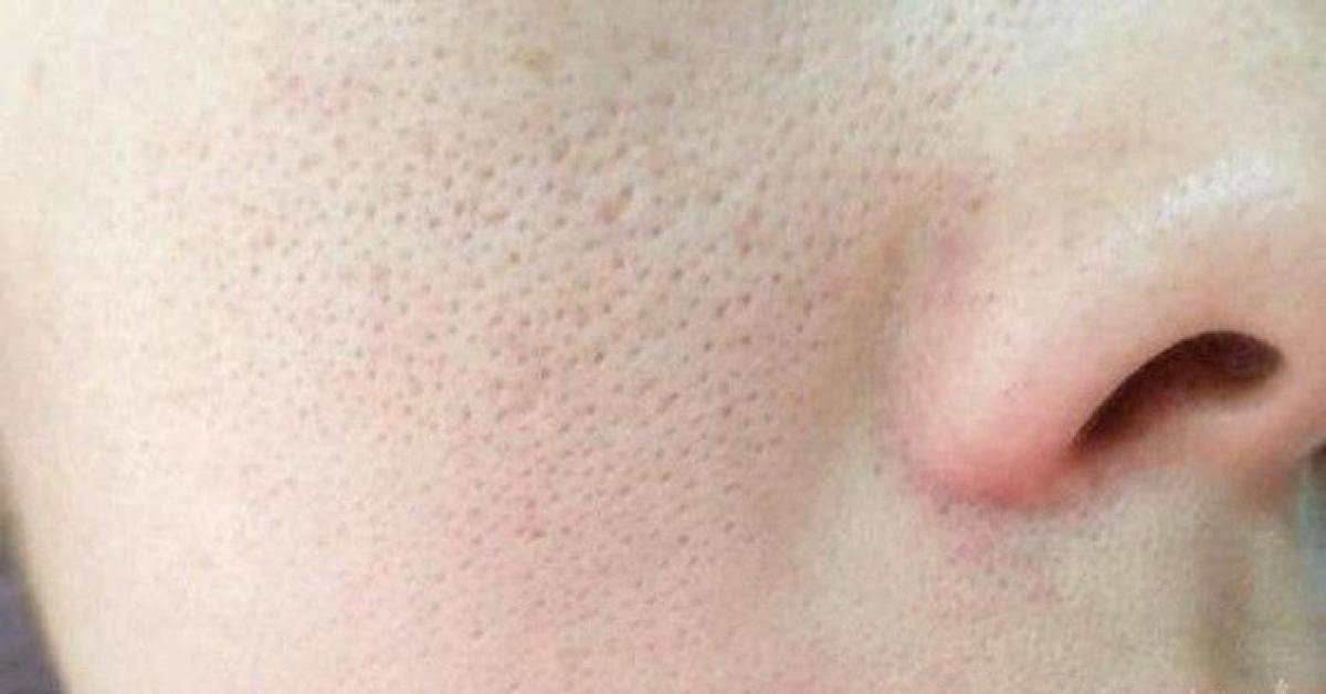 Ternyata Ini Rahasia Mengecilkan Pori-pori, Bikin Wajah Jadi Halus dan Lebih Cerah