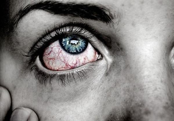 Mata Merah dan Belekan, Ini Penyebabnya Menurut Dokter