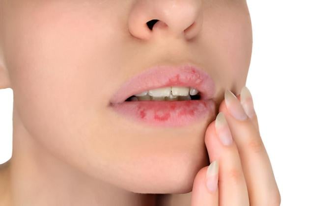 Ini Cara Mengatasi Bibir Kering yang Efektif dan Aman