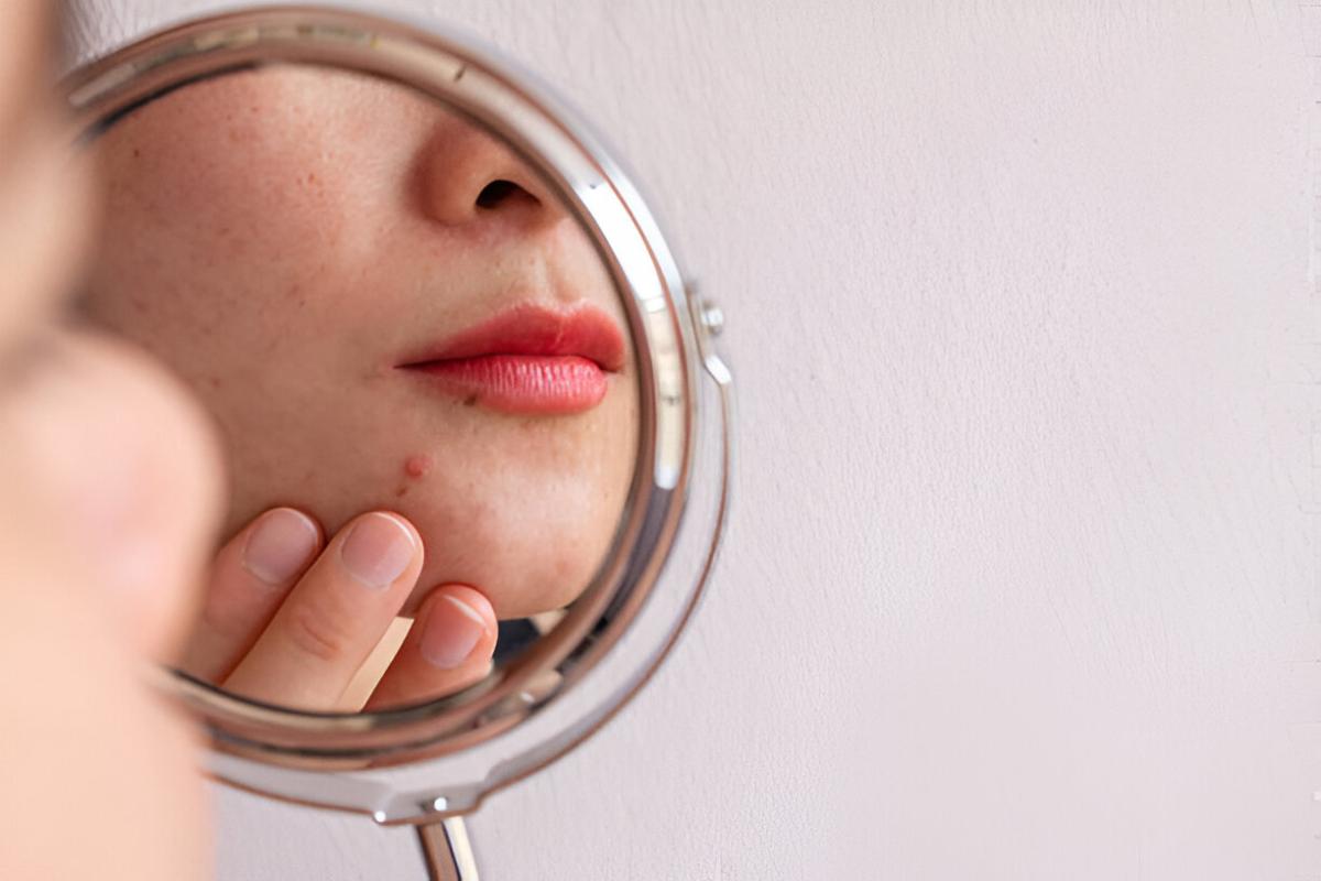 Kenali Kandungan Skincare untuk Kulit Berjerawat yang Aman dan Efektif
