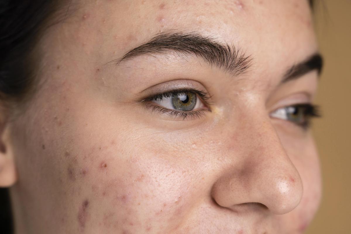Tips Menggunakan Acne Spot Treatment Agar Jerawat Cepat Kering dan Bekas Tidak Gelap