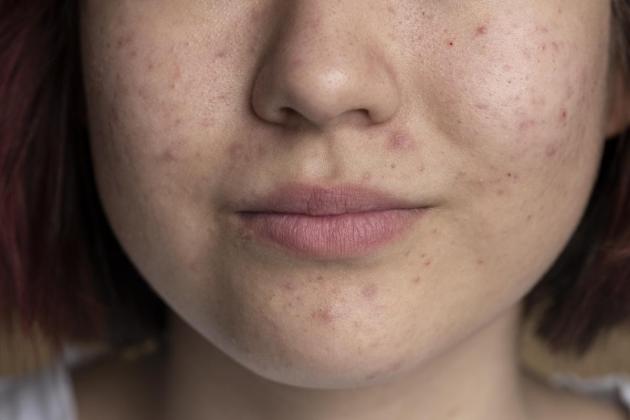 Fungal Acne: Cara Cepat Mengatasi Jerawat Jamur yang Sering Disangka Bruntusan