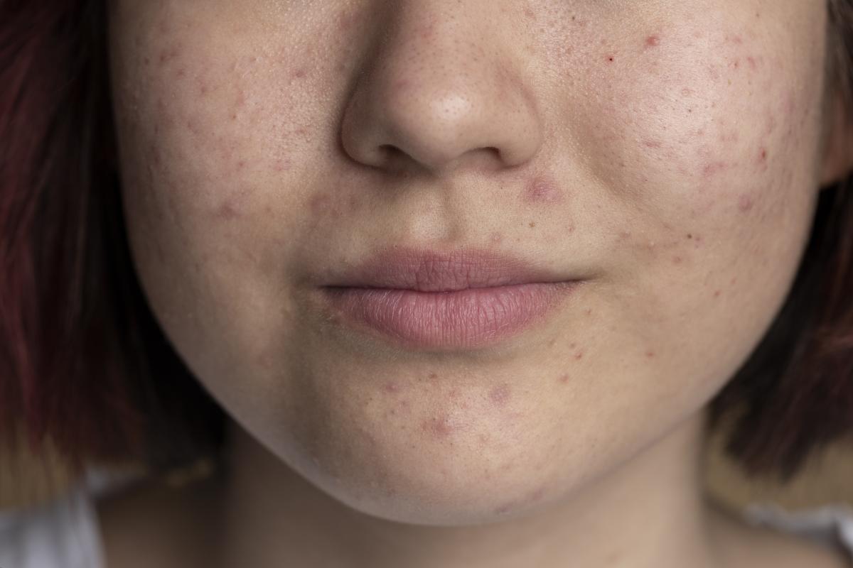 Fungal Acne: Cara Cepat Mengatasi Jerawat Jamur yang Sering Disangka Bruntusan