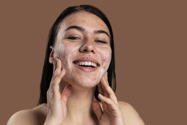 Jerawat Tak Kunjung Hilang? Bisa Jadi Ini 5 Kesalahan Skincare yang Masih Sering Kamu Lakukan