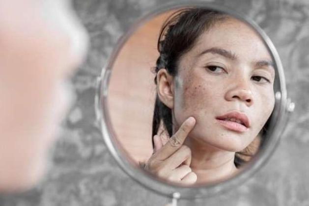 5 Cara Ampuh Hilangkan Flek Hitam di Wajah Secara Alami, Nomor 2 Paling Gampang !!!