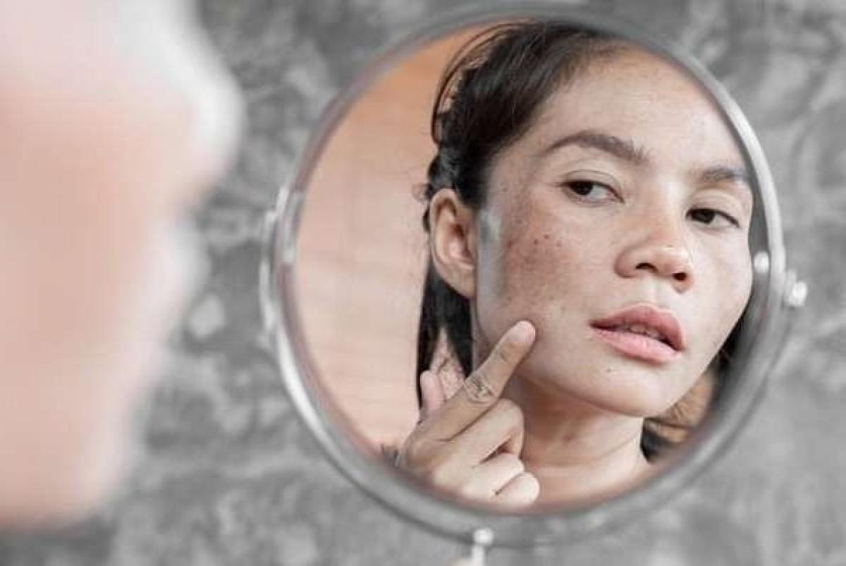 5 Cara Ampuh Hilangkan Flek Hitam di Wajah Secara Alami, Nomor 2 Paling Gampang !!!