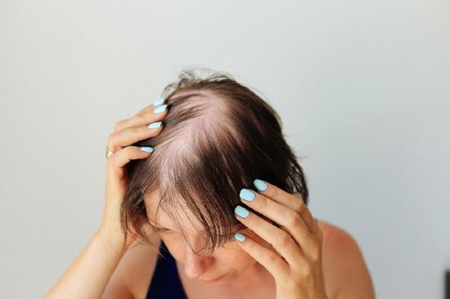 Perang Lawan Kebotakan: 4 Rekomendasi Obat Penumbuh Rambut Paling Ampuh