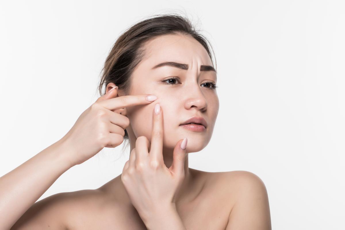 Awas Breakout! Kenali Kandungan Skincare yang Bikin Wajah Purging