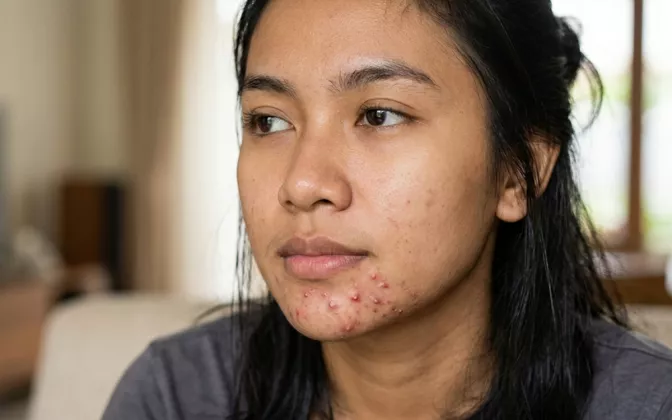 Penyebab Jerawat Muncul Berulang di Titik yang Sama dan Cara Mengatasinya