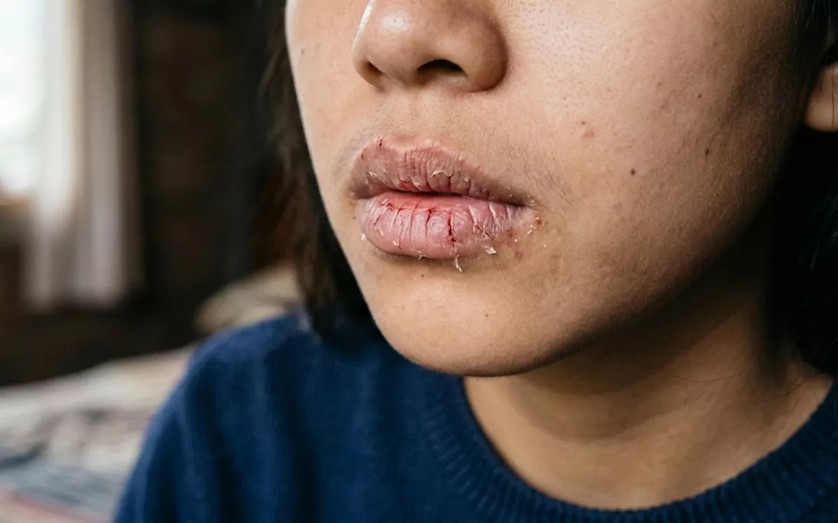 Cara Mengatasi Bibir Pecah-Pecah Saat Puasa Secara Alami dan Efektif