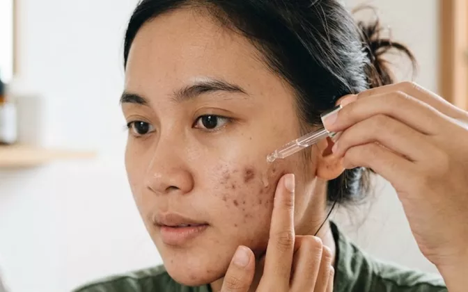 Serum Penghilang Bekas Jerawat Terbaik 2026: Wajah Mulus Tanpa Noda Hitam!
