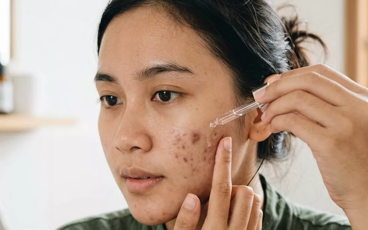 Serum Penghilang Bekas Jerawat Terbaik 2026: Wajah Mulus Tanpa Noda Hitam!