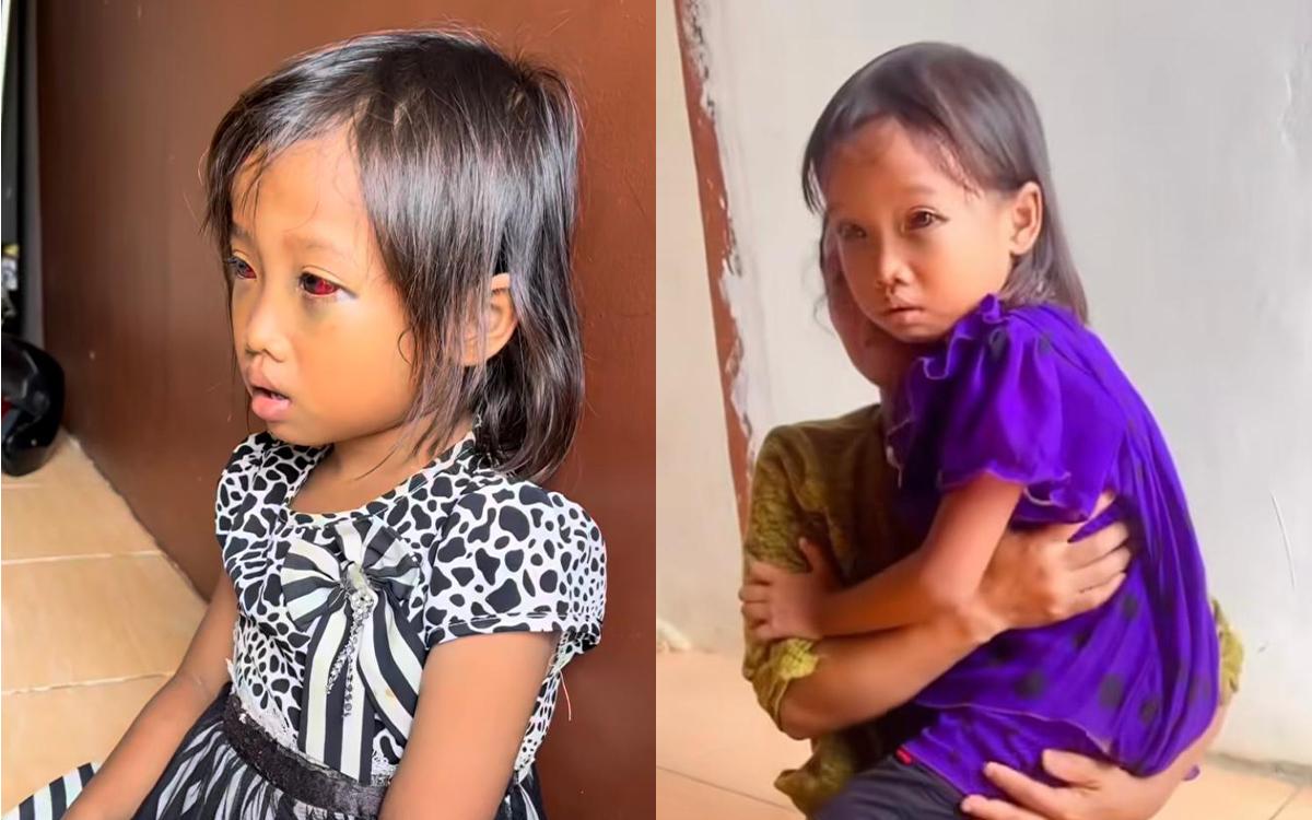 Siswi SD Pulang dengan Mata Lebam, Publik Desak Aksi Tegas dari Pihak Sekolah