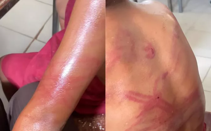 Hati Teriris! Ayah Tega Siksa Anak Kandung Pakai Kabel Charger Hingga Luka Parah