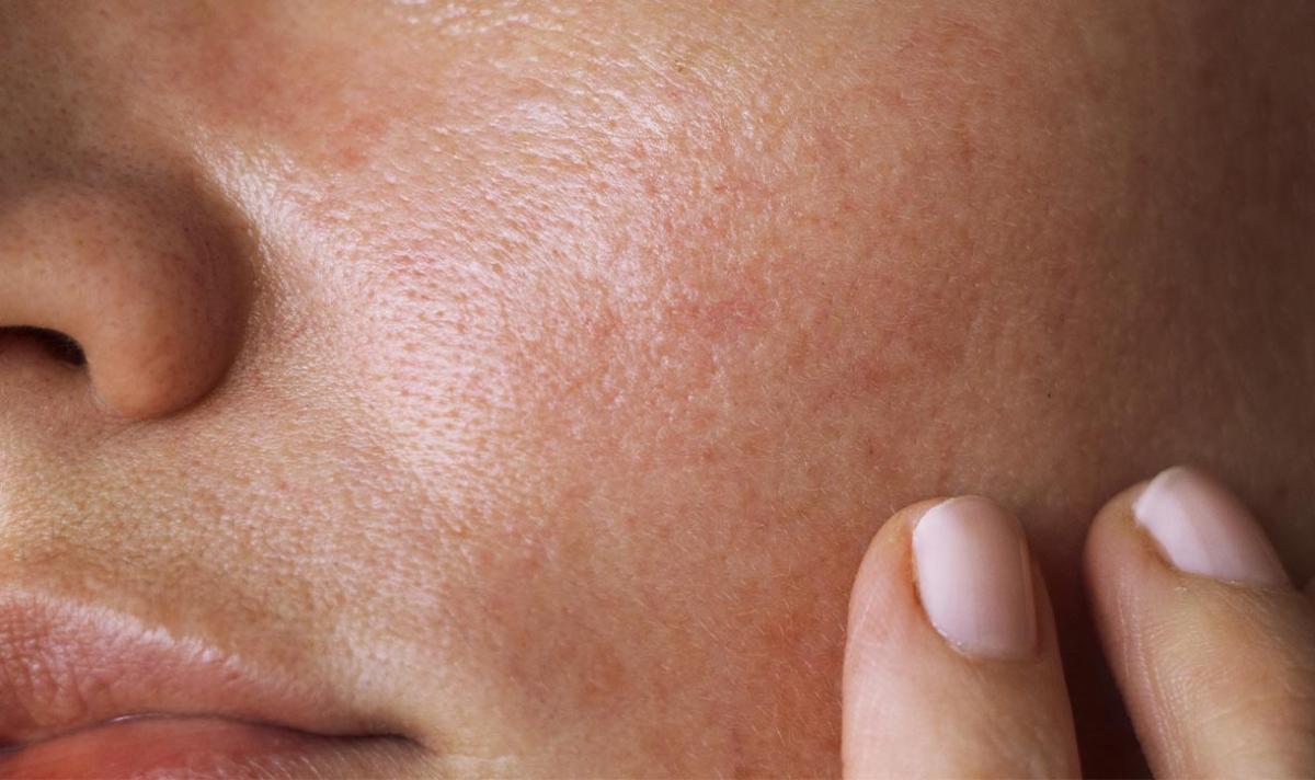 Basic Skincare untuk Kulit Oily, Glowing Sehat Tanpa Kilap Berlebih