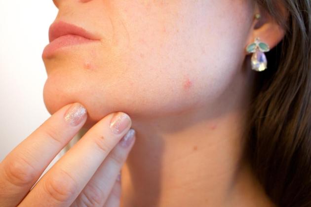 Mengatasi Jerawat dengan Acne Patch: Pilihan Terbaik untuk Kulit Bersih dan Sehat
